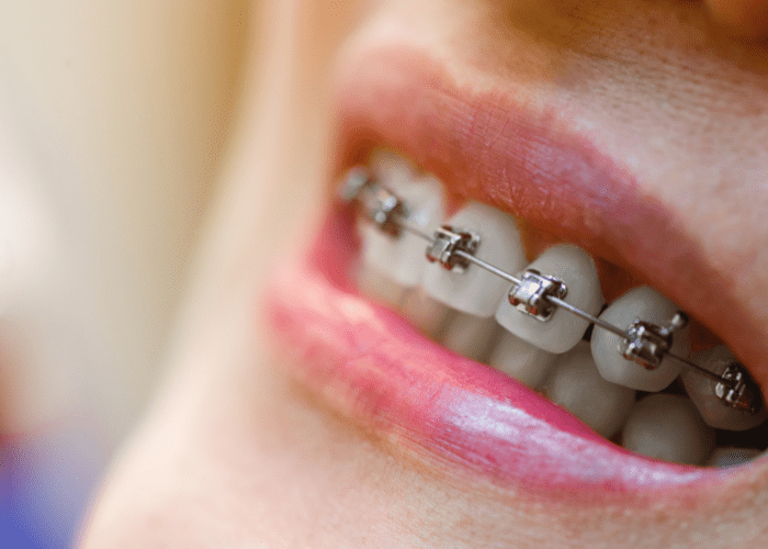 Brackets autoligado