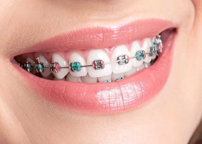 Brackets