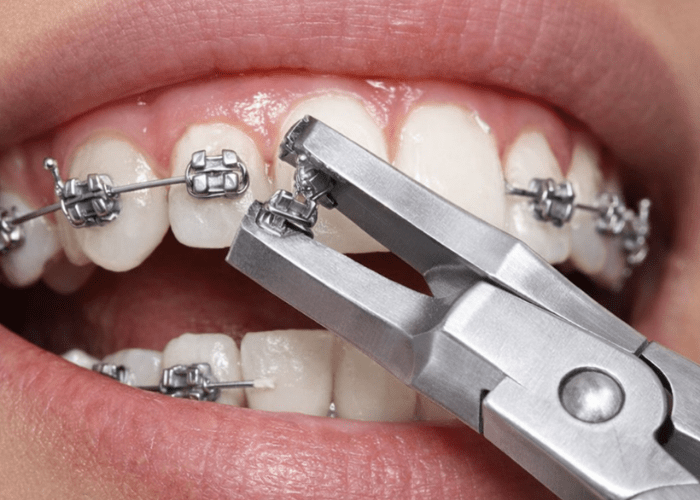 Retiro de brackets