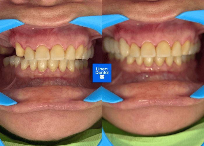 Corona dental Obregón